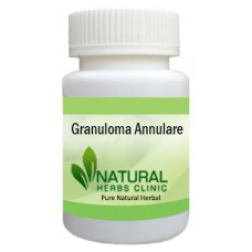 Natural Herbal Treatment For Granuloma Annulare